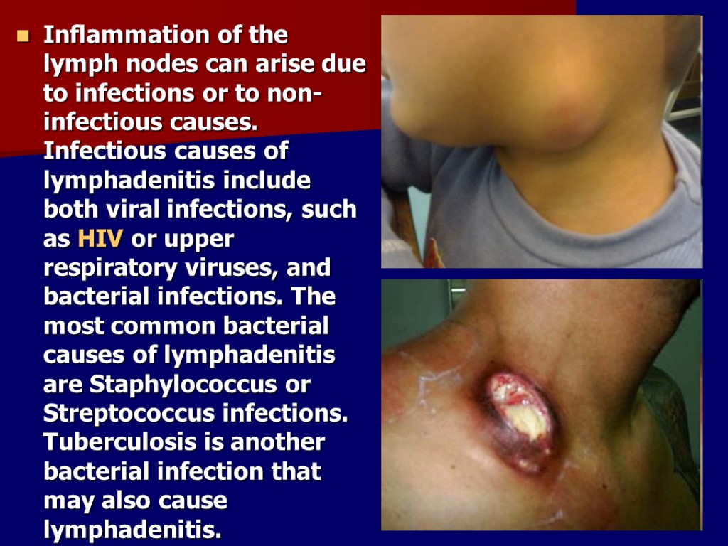 Inflammation of the lymph nodes can arise due to infections or to non-infectious causes.